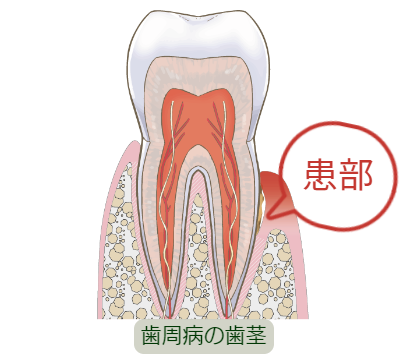 歯周病の歯茎