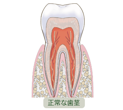 歯周病の歯茎